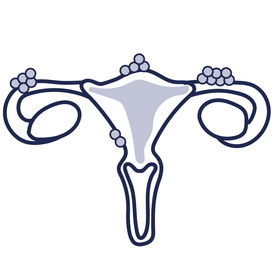 Endometriosis