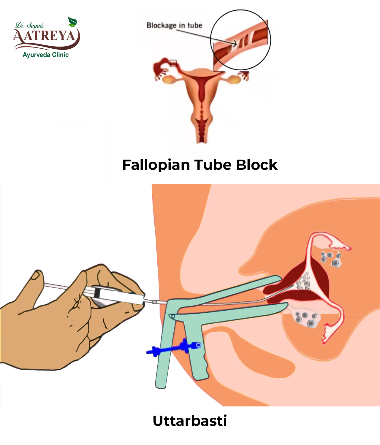 Ayurvedic Clinic for Tubal Block in Pimple Nilakh  | Aatreya Ayurveda Clinic